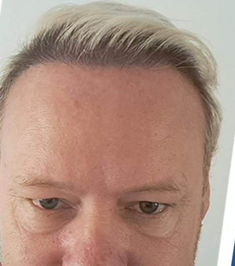 After a 2,700 graft transplant
