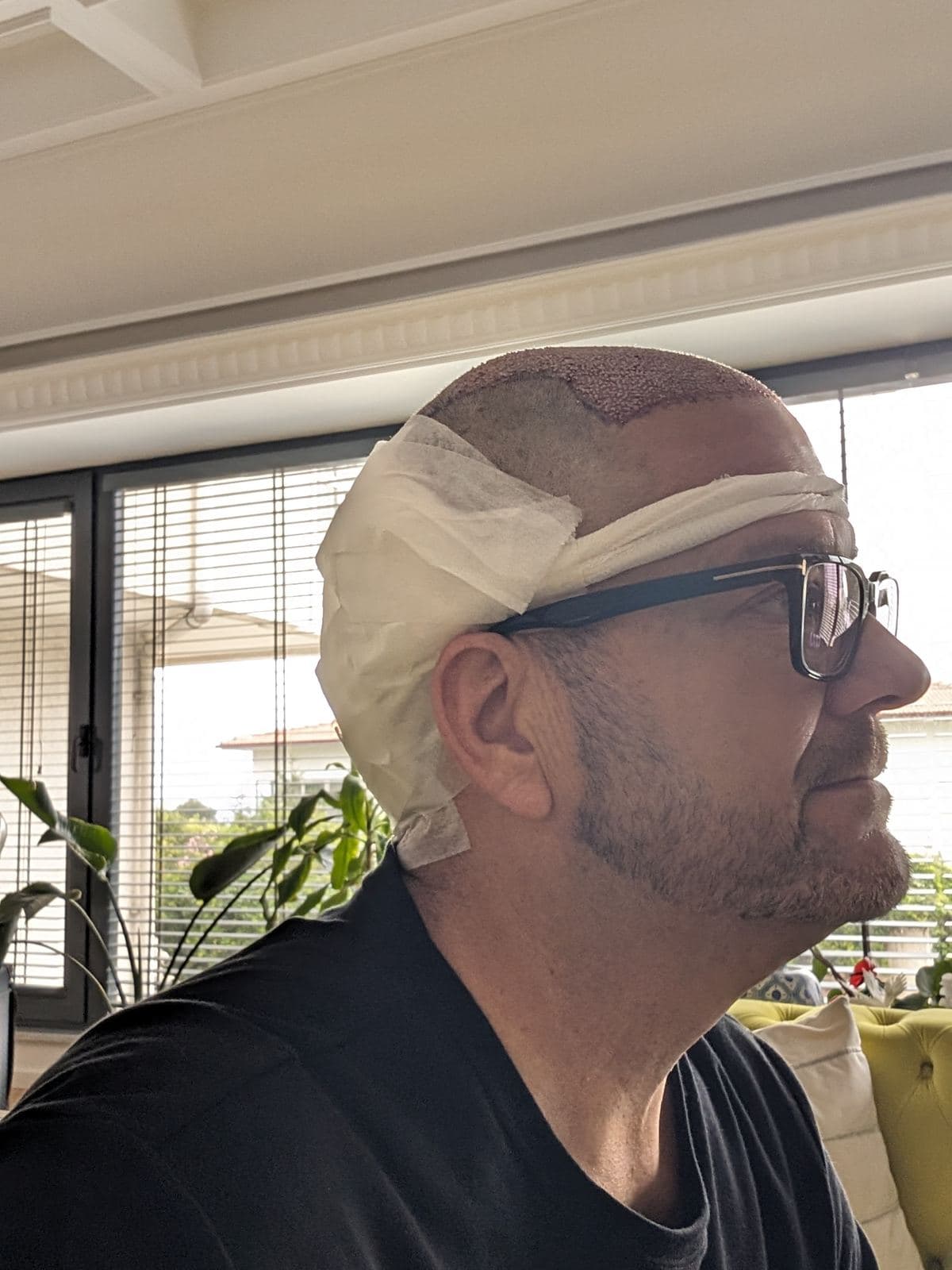 Tom at the clinic in Istanbul wearing a post procedure headband