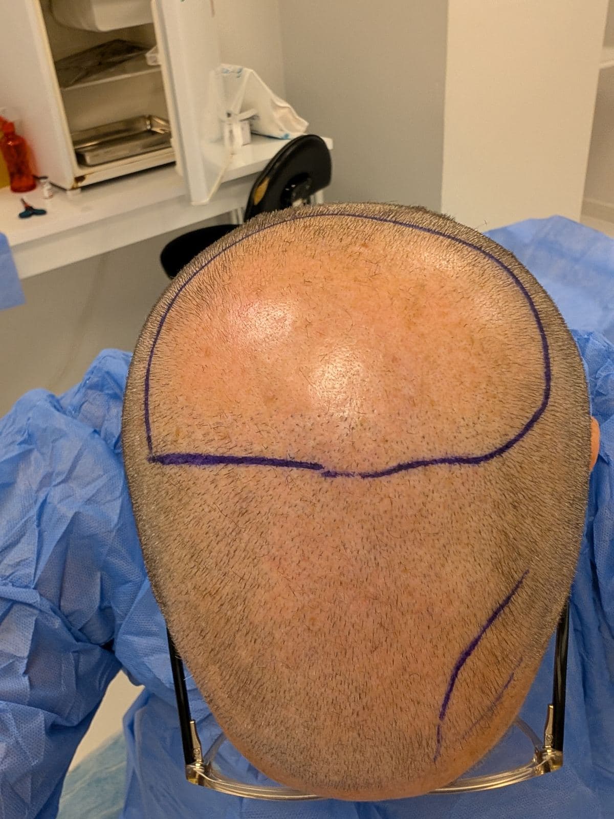 Tom's hairline drawn in surgical marker before the procedure