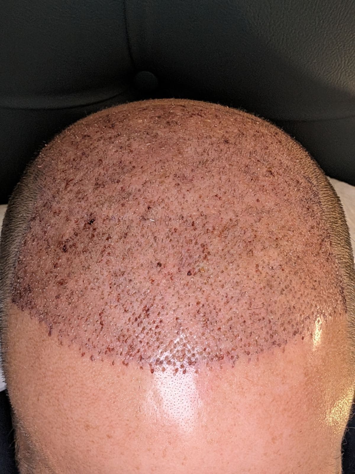 Close view of newly placed grafts across the hairline